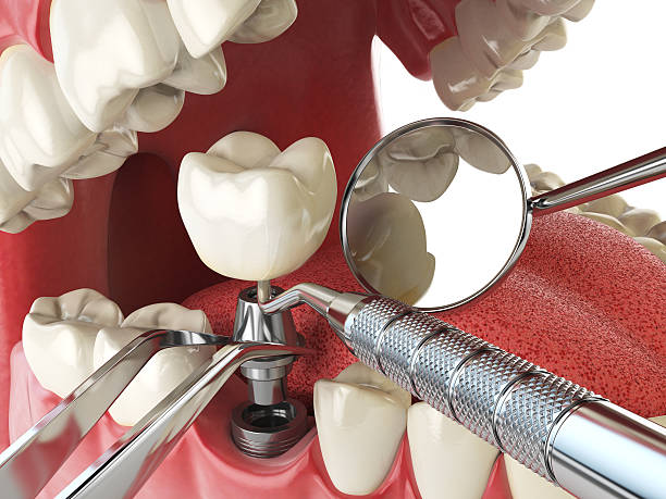 Best Urgent Care for Lost Fillings or Crowns in Williamsport, PA